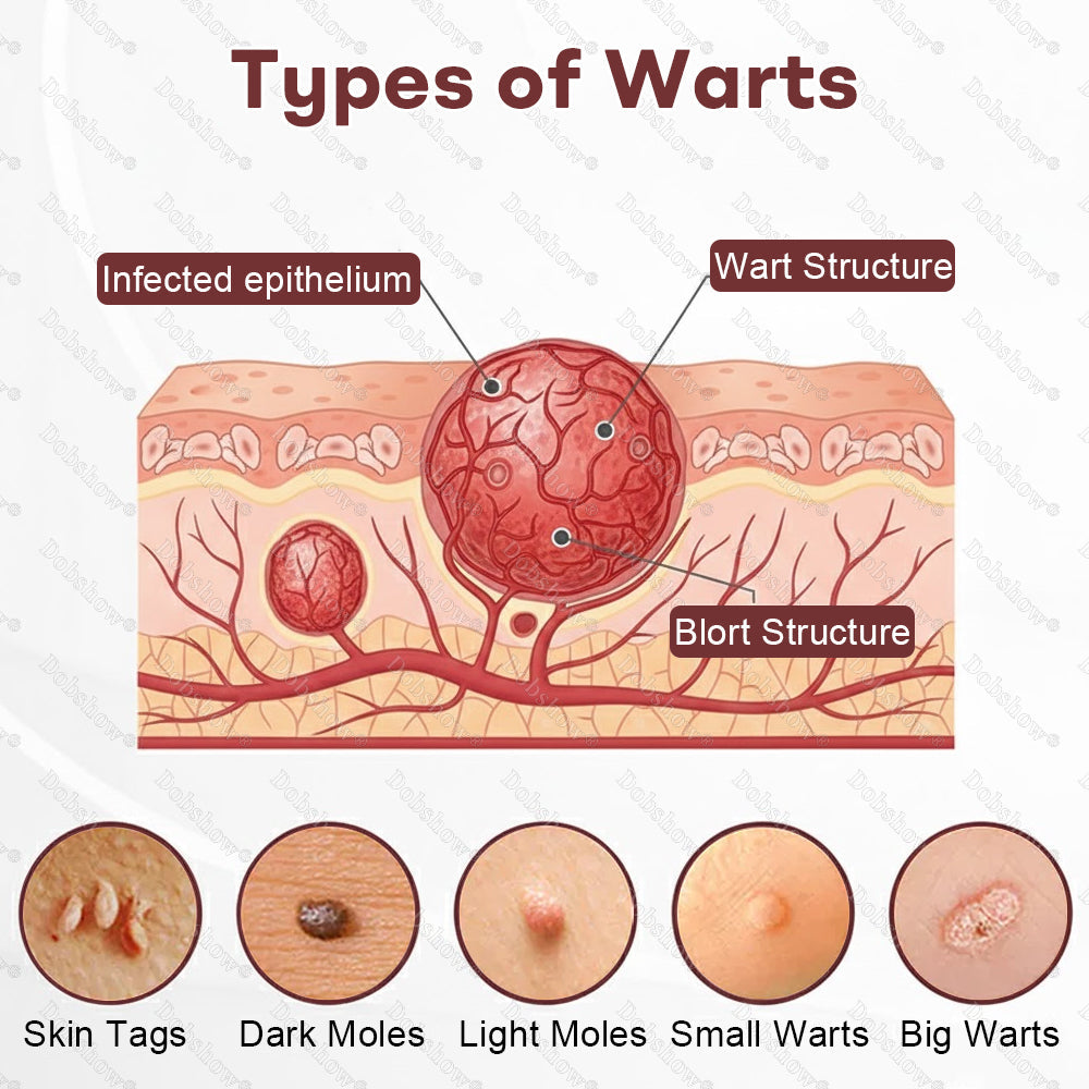🌿Healrize® BlackRice DermCorrect™ Wart Recovery Cream| Suitable for all skin types