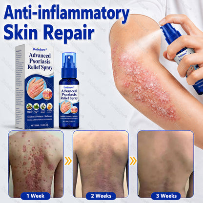 🔥Dobshow® Advanced Psoriasis Relief Spray