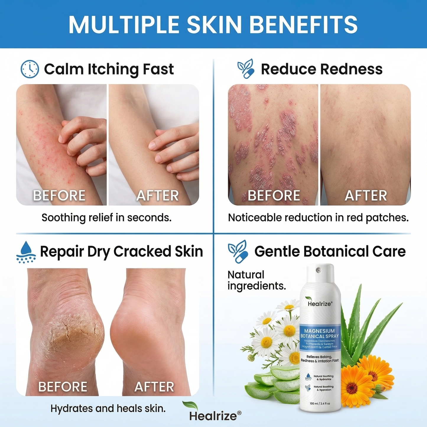 👨‍⚕️🔥Healrize® Magnesium Botanical Spray –✅Advanced Skin Recovery for Psoriasis & Eczema | Rapid Soothing, Steroid-Free🌿