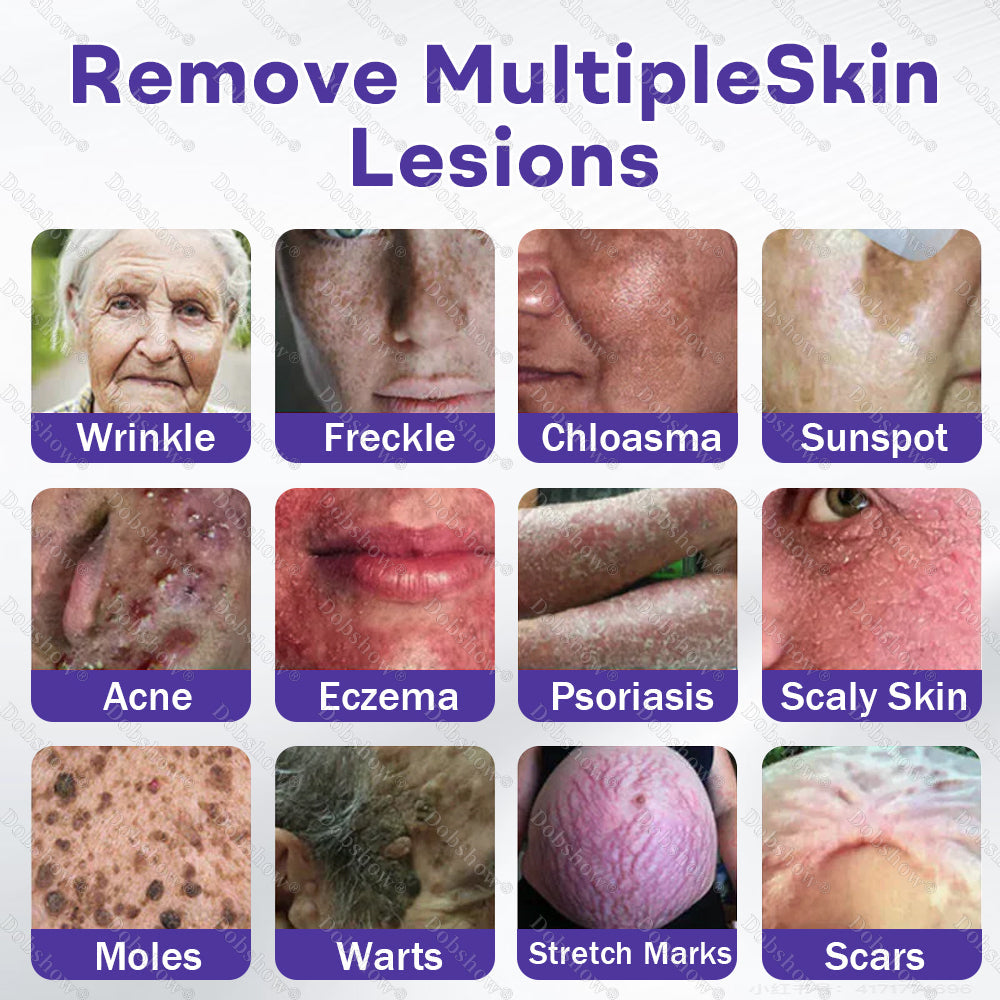 ✨🔥Dobshow® Wart and mole removal microneedle patch