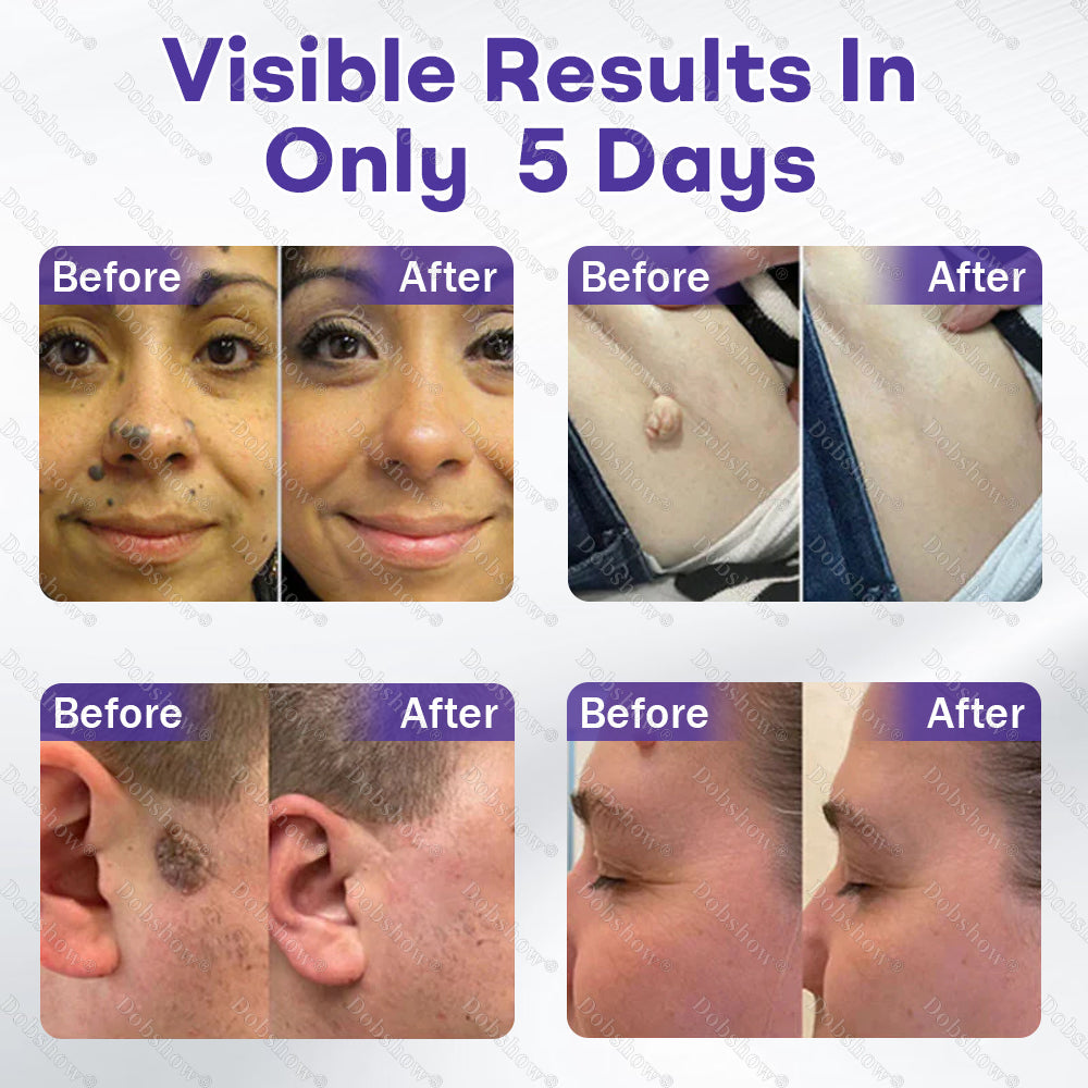 ✨🔥Dobshow® Wart and mole removal microneedle patch