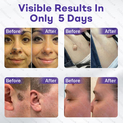 ✨🔥Dobshow® Wart and mole removal microneedle patch