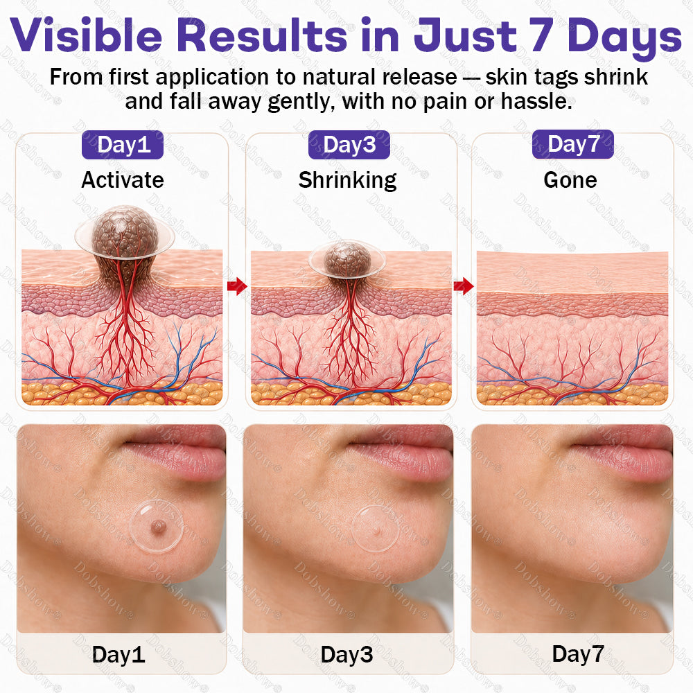 ✨🔥Dobshow® Wart and mole removal microneedle patch