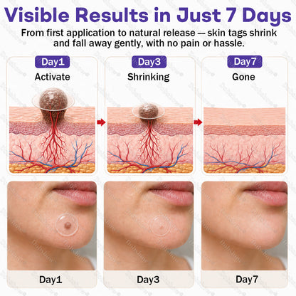 ✨🔥Dobshow® Wart and mole removal microneedle patch