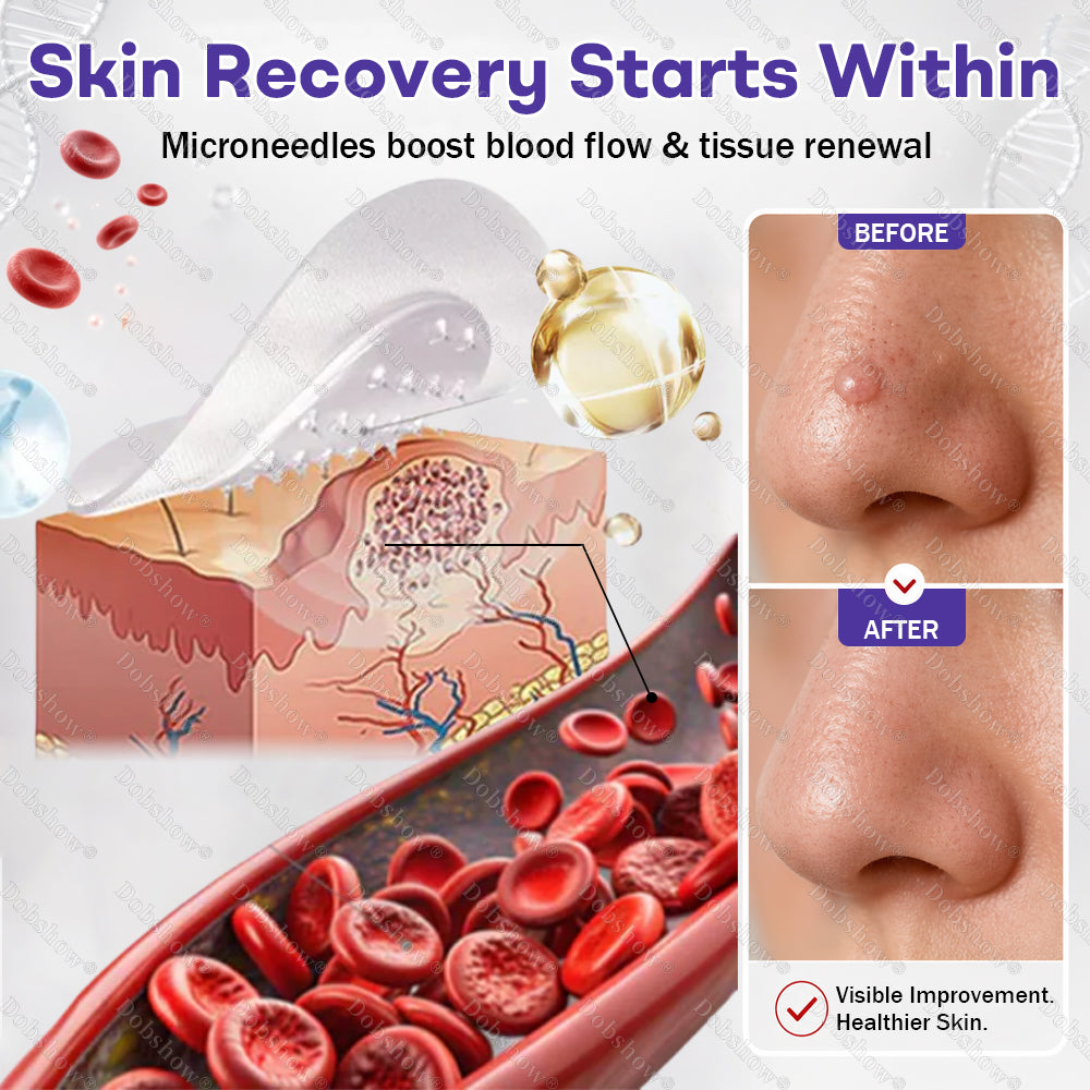 ✨🔥Dobshow® Wart and mole removal microneedle patch