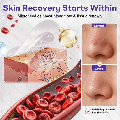 ✨🔥Dobshow® Wart and mole removal microneedle patch