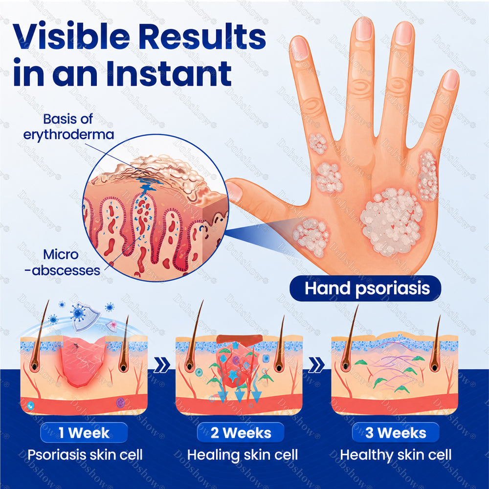 🔥Dobshow® Advanced Psoriasis Relief Spray